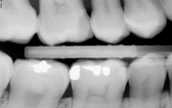 phim x-quang cánh cắn