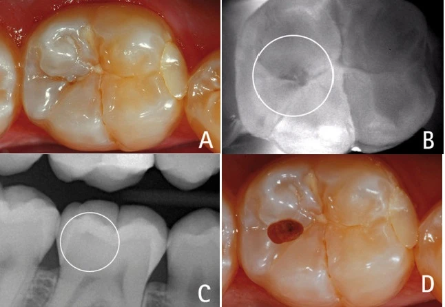 lỗ sâu nhỏ trên mặt nhai
