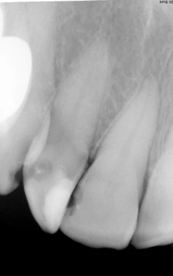 thông thường xé thấu quang trên phim X-quang