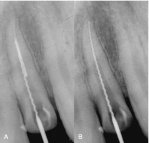 băng đầu qua mũi bằng pesse