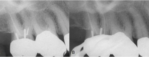 Phòng tránh hiện tượng gãy dụng cụ trong ống tủy và cách xử lý thăm dò nội nha