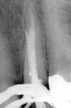 chấn thương nặng do gãy dụng cụ