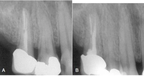 thất bại khi dùng sai mũi khoan