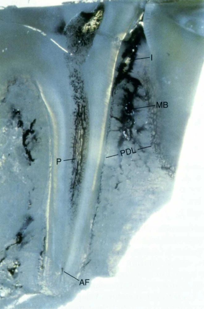 CÁC KỸ THUẬT GÂY TÊ TRONG ĐIỀU TRỊ TỦY RĂNG ky-thuat-gay-te-trong-dieu-tri-tuy-4