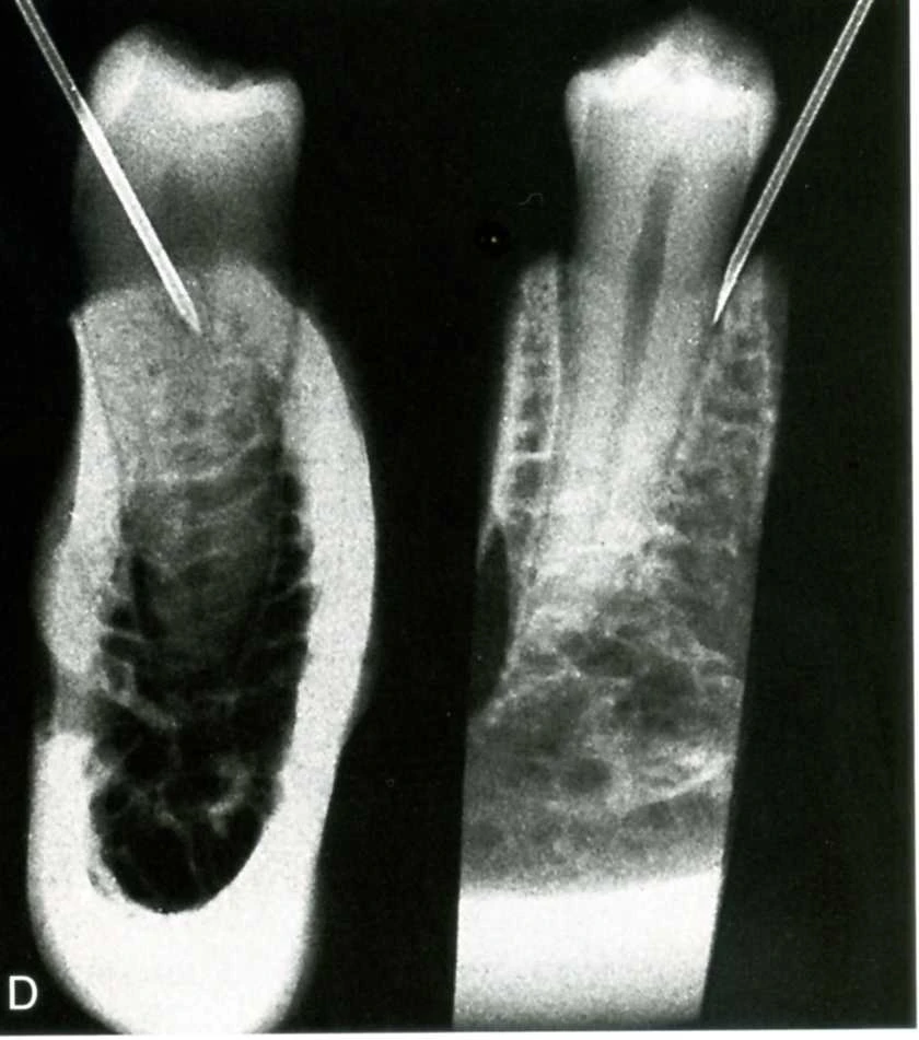 ky-thuat-gay-te-trong-dieu-tri-tuy-5