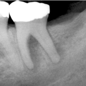 Nứt & gãy chân răng ( phần 1) - 159 file