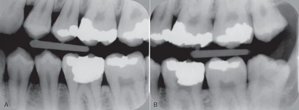 Phim cánh cắn phần hàm trái của bệnh nhân.