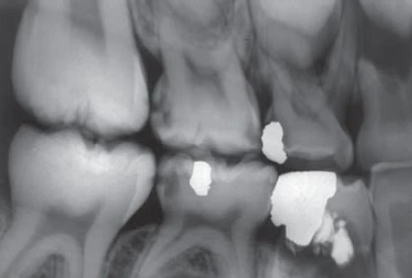 Phim cánh cắn ở bộ răng hỗn hợp cho thấy tổn thương sâu ngà ở mặt gần