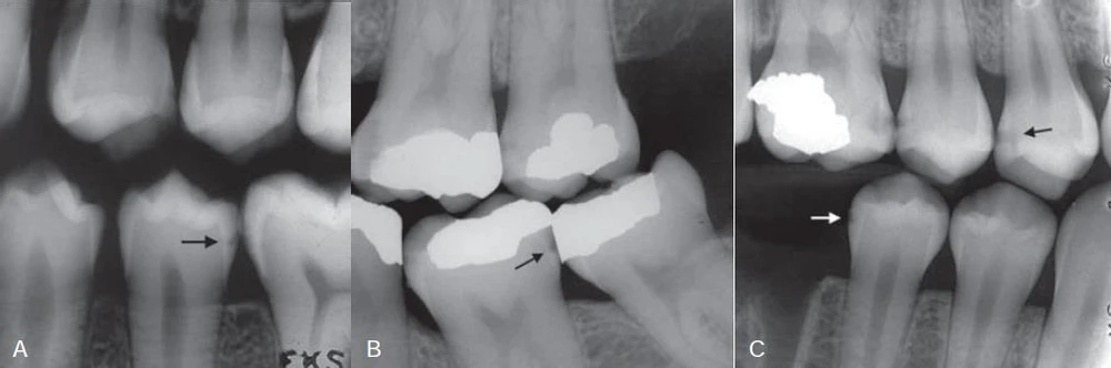 Phim cánh cánh thể hiện sâu răng mặt bên (mũi tên) sâu răng