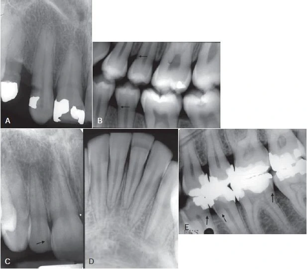 hình ảnh dương tính giả (mũi tên)