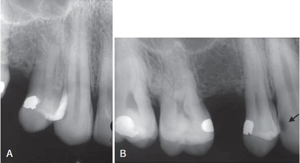 Hình ảnh mặt xa răng nanh không nhìn rõ. B