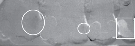 Phim X quang kỹ thuật số với kỹ thuật chồng phim và loại trừ hình ảnh