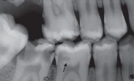 Tổn thương sâu răng mặt ngoài (mũi tên)