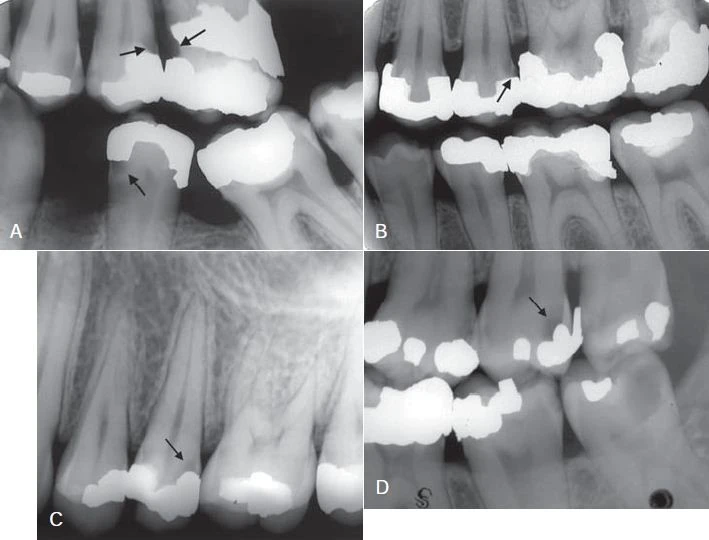 Sâu răng cạnh miếng trám.