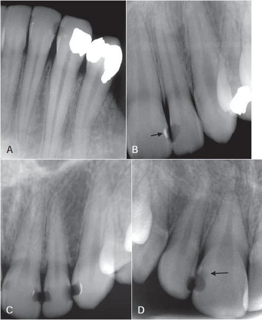 Vật liệu trám không cản quang
