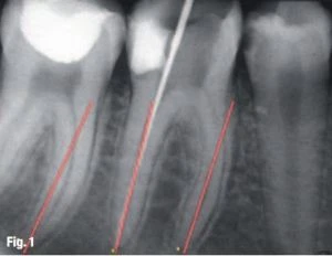 Quyết định chiều dài làm việc và cách xác định điểm chóp cuối cùng 