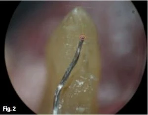 Quyết định chiều dài làm việc và cách xác định điểm chóp cuối cùng  lỗ chóp phẫu thuật