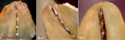 Quyết định chiều dài làm việc và cách xác định điểm chóp cuối cùng  4