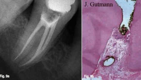 điểm thắt chóp sinh lý