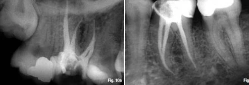 điểm chóp cuoiió răng trên Xquang