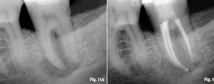 trường hợp viêm quanh chóp