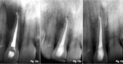 Quyết định chiều dài làm việc và cách xác định điểm chóp cuối cùng  tại điểm chóp phẫu thuật