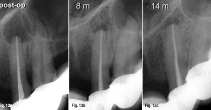 Bệnh lý kèm tiêu chân