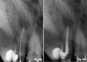 Quyết định chiều dài làm việc và cách xác định điểm chóp cuối cùng  3