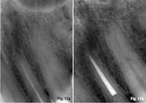 Quyết định chiều dài làm việc và cách xác định điểm chóp cuối cùng  6