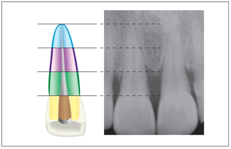 CHIẾN LƯỢC VƯƠN TỚI CHÓP RĂNG Chiều dài ống tủy