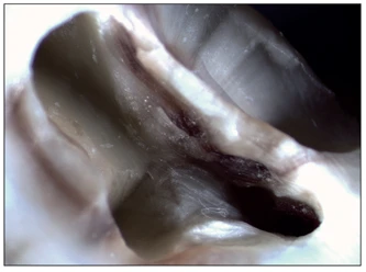 CHIẾN LƯỢC VƯƠN TỚI CHÓP RĂNG Lỗ tủy răng