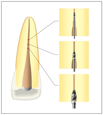 CHIẾN LƯỢC VƯƠN TỚI CHÓP RĂNG Mũi tên đo ống tủy