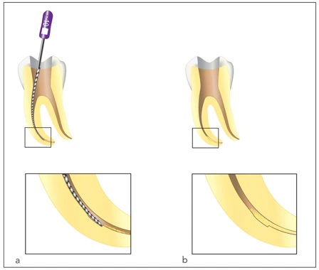 CHIẾN LƯỢC VƯƠN TỚI CHÓP RĂNG khấc khi điều trị tủy