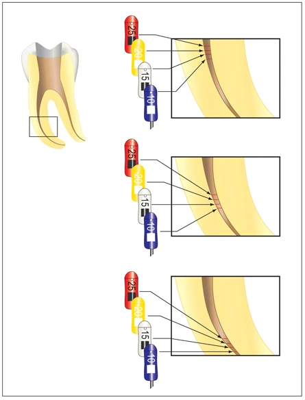 CHIẾN LƯỢC VƯƠN TỚI CHÓP RĂNG định vị chóp