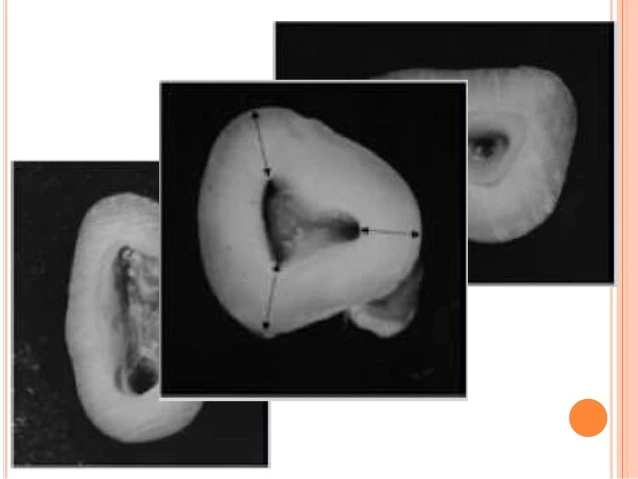 Các quy luật mở tủy trong điều trị nội nha QUY LUẬT ĐỒNG DẠNG