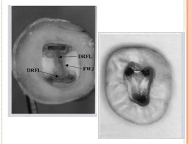 Các quy luật mở tủy trong điều trị nội nha QUY LUẬT ĐỔI MÀU