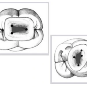 Các quy luật mở tủy trong điều trị nội nha hiện nay - 213 file