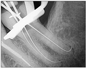 Các Tai Biến Khi Tạo Hình Ống Tủy