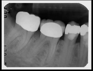 Phim cánh cắn tại sao lại quan trọng khi kiểm tra chụp răng