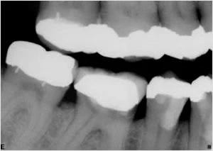 Phim cánh cắn tại sao lại quan trọng khi kiểm tra chụp răng
