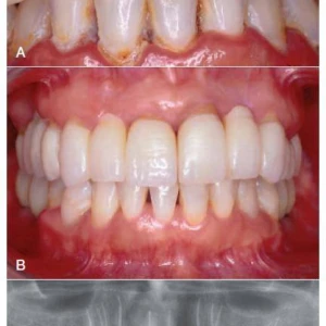 Điều trị tủy: làm sạch và tạo hình ống tủy toàn diện - 241 file