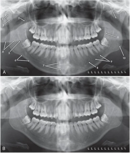 Cấu trúc giải phẫu xương trên phim x-quang toàn cảnh