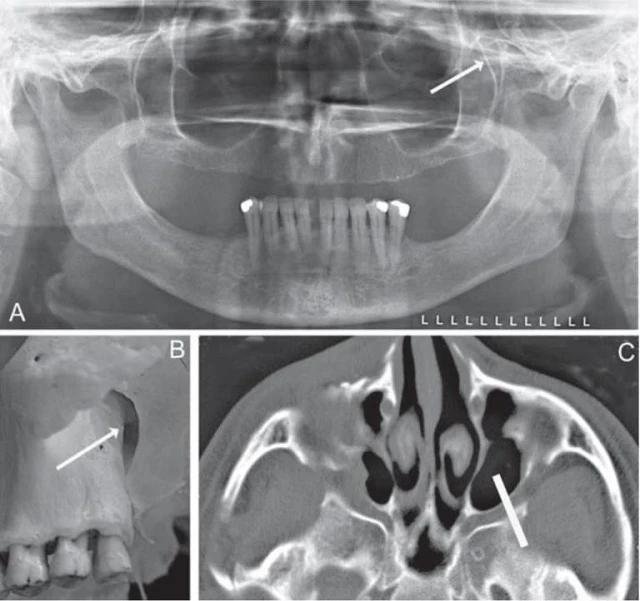 Rãnh chân bướm hàm, một khoảng trống giữa mặt sau xương hàm trên và bờ trước của cánh chân bướm