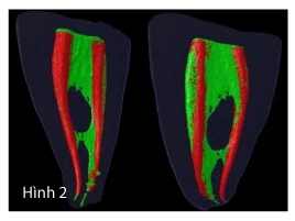Điều Trị Nội Nha Lại: Đạt Tới Thành Công Trong Lần Điều Trị Thứ Hai bệnh lý sau điều trị