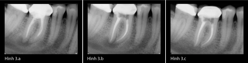 bệnh lý sau điều trị 1