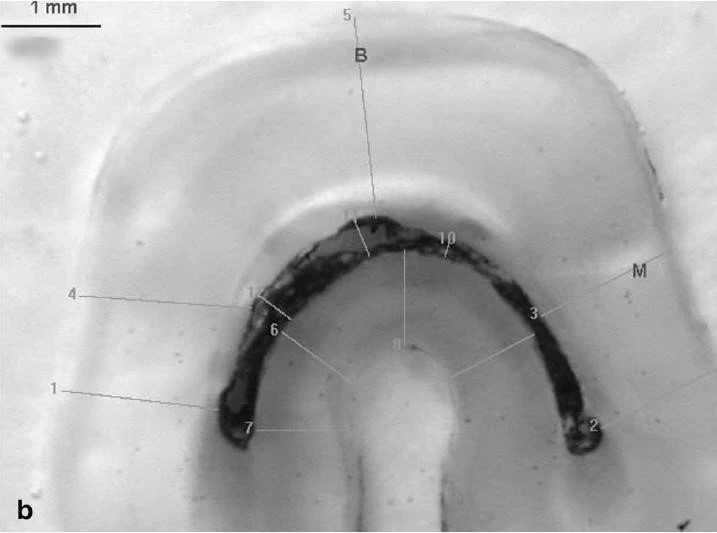 Ống tủy hình chữ C 1