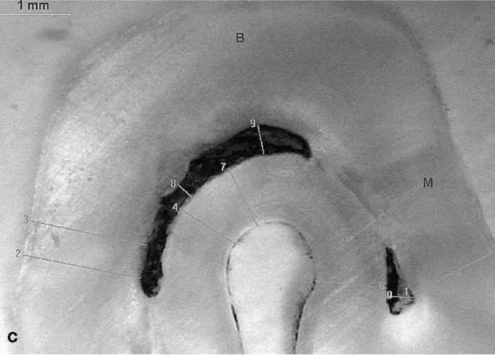 Ống tủy hình chữ C 2