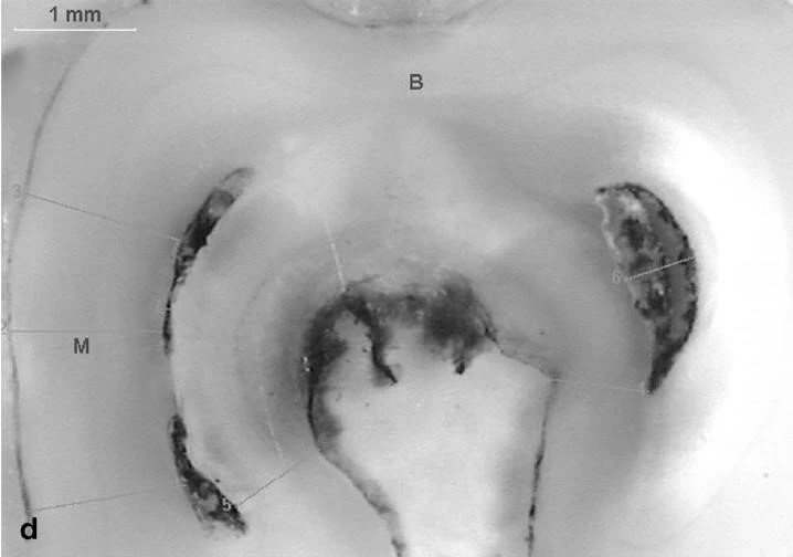 Ống tủy hình chữ C 3