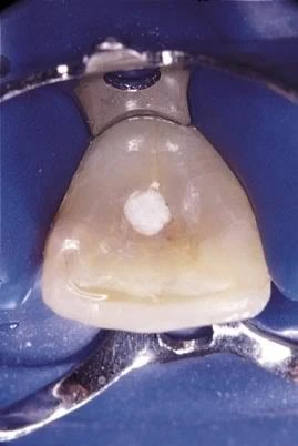 NHỮNG SAI SÓT TRONG MỞ TỦY