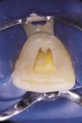 mở rộng trần tủy